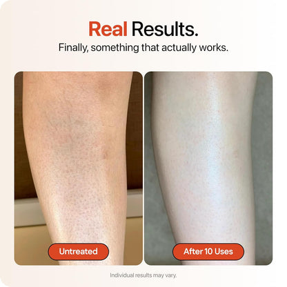 Advanced Triple-Acid Complex for Keratosis Pilaris