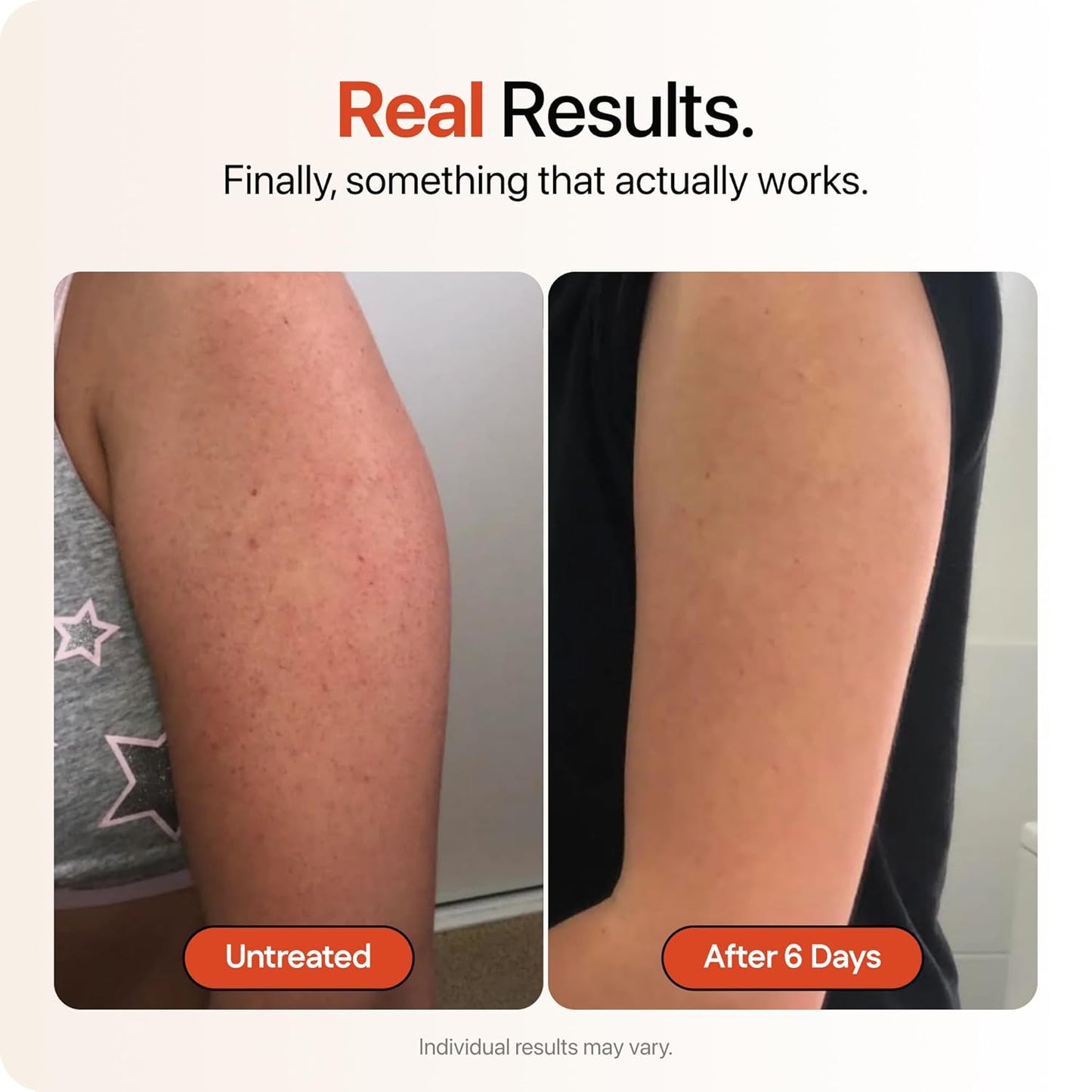 Advanced Triple-Acid Complex for Keratosis Pilaris