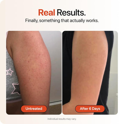 Advanced Triple-Acid Complex for Keratosis Pilaris